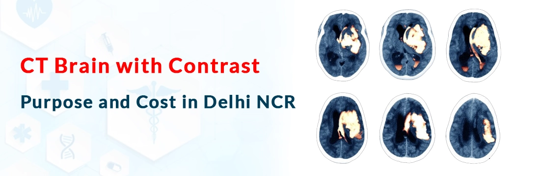 CT Brain with Contrast: Purpose and Cost in Delhi NCR